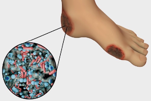 an illustration of a foot ulcer