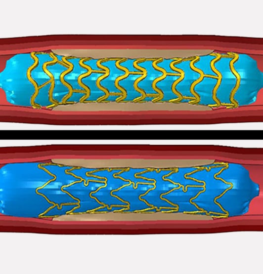 Stents diagram