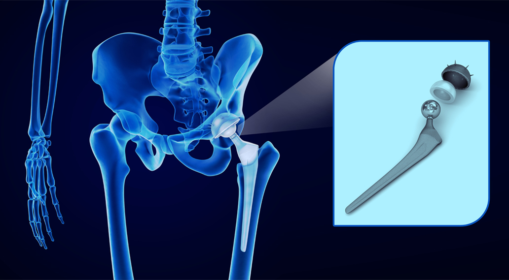Photograph showing a hip replacement device and where it sits in the human body