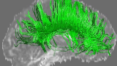 Computer visualizations of human brain fibre tracking and human calf fascicle tracking