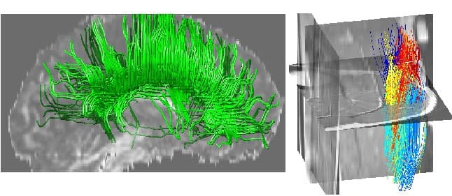 Computer visualizations of human brain fibre tracking and human calf fascicle tracking