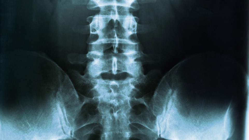 Spine x-ray