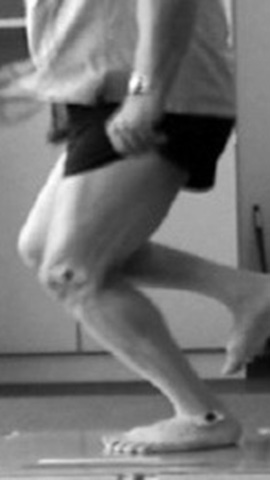 A patient performing a hopping test