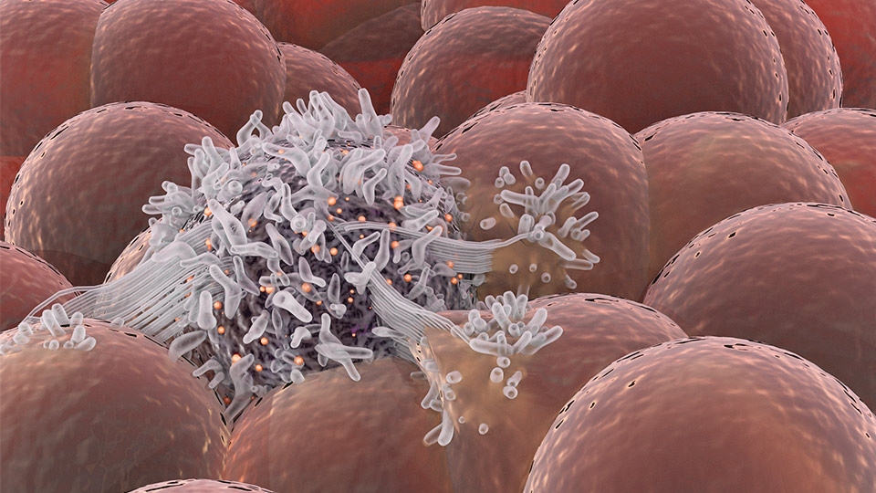 Breast cancer cell in body cells. 