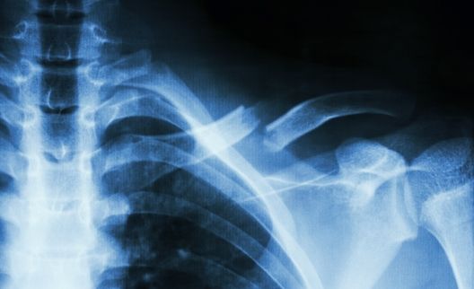 X-ray photo to promote news story of tissue regeneration method