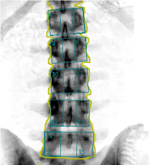 Xray of spine